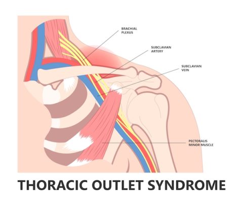 Thoracic Outlet Syndrome The Surgical Clinic