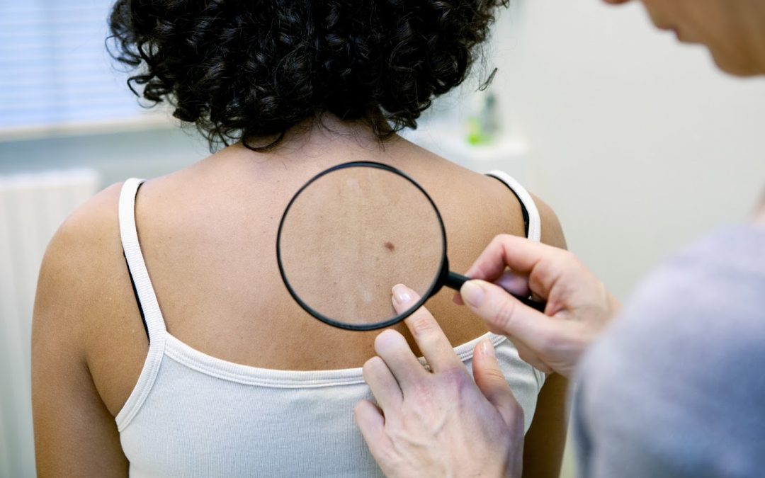 Understand Skin Moles and Know When to Remove Them