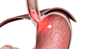 Bad-valve Bad valve GERD symptoms
