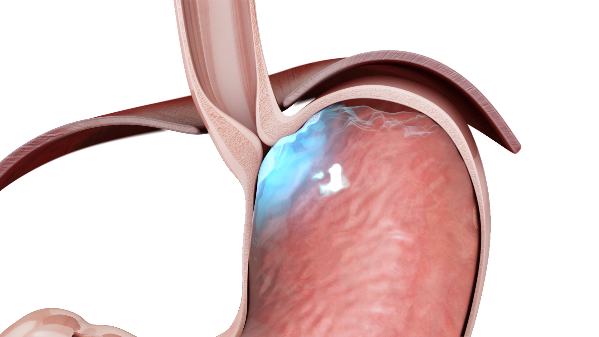 What Does Hill Grade 1 Gastroesophageal Flap Valve Mean