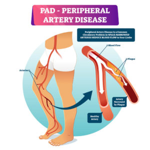 A diagram showing how peripheral artery disease is caused by blockages in the arteries. Find treatment for PAD at The Surgical Clinic in Middle Tennessee