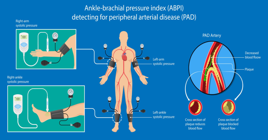 Diagram of the ankle-brachial index (ABPI) test for detecting peripheral arterial disease (PAD)