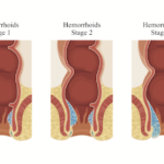 hemorrhoid treatment hemorrhoid removal HAL RAR TSC rutherford best hemorrhoid doctor