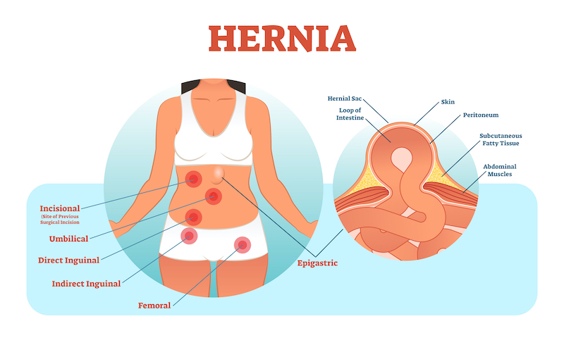 hernia surgery nashville dr trudie goers