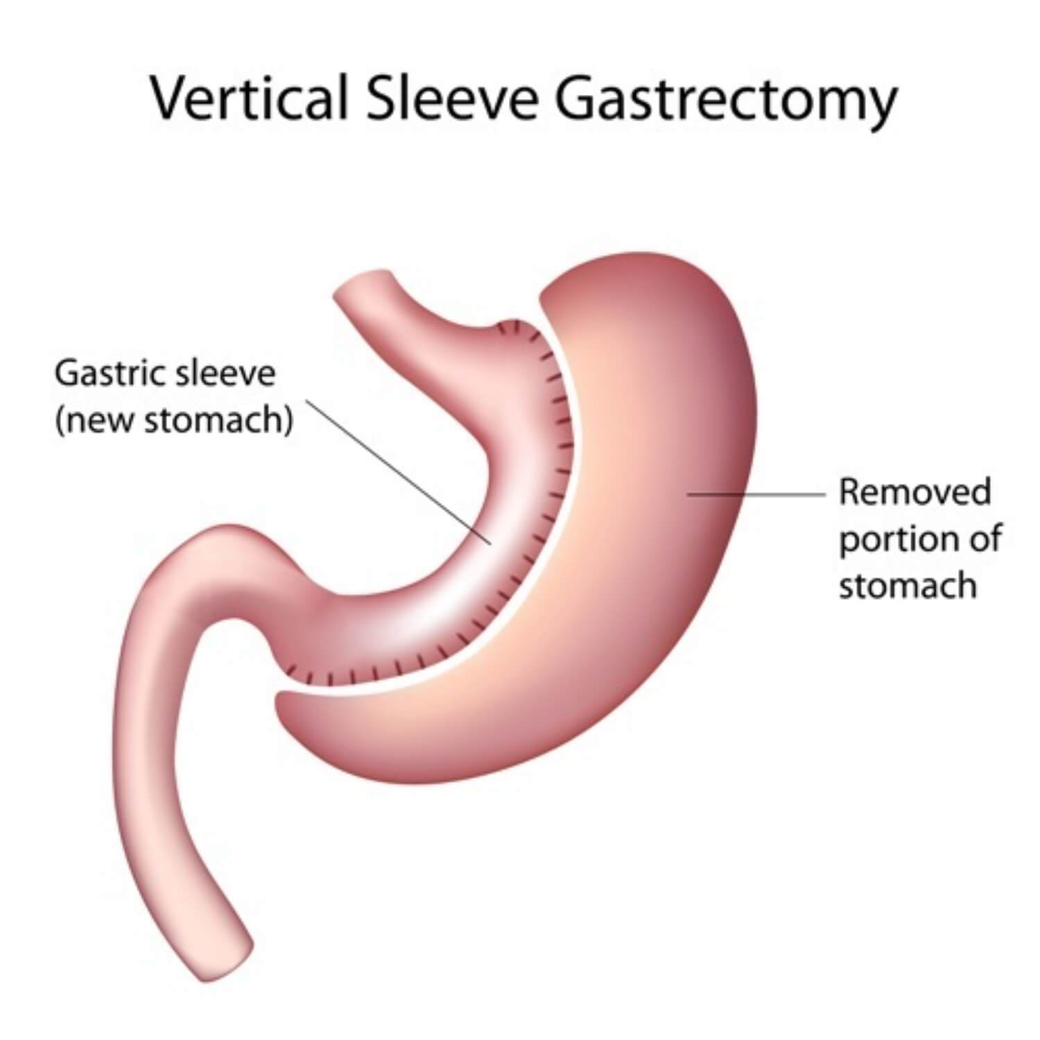 Vertical sleeve gastrectomy from bariatric surgeons in tennessee