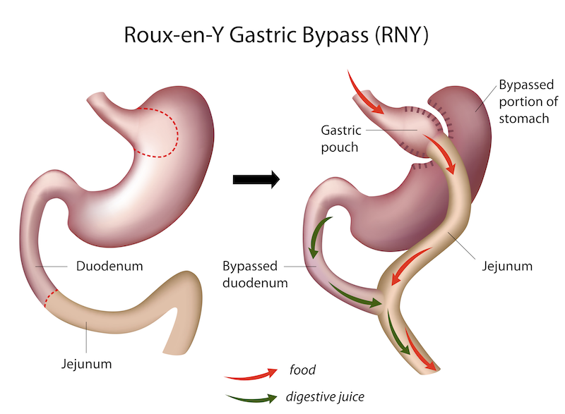 bariatrics nashville weight loss surgery roux-en-y gastric bypass RNY