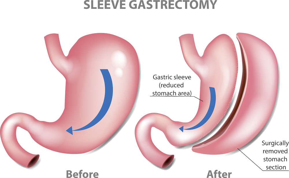 bariatrics sleeve gastrectomy