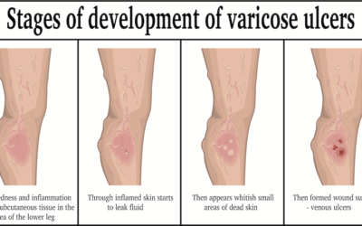 Don’t Become Sidelined with Recurring Leg Ulcers