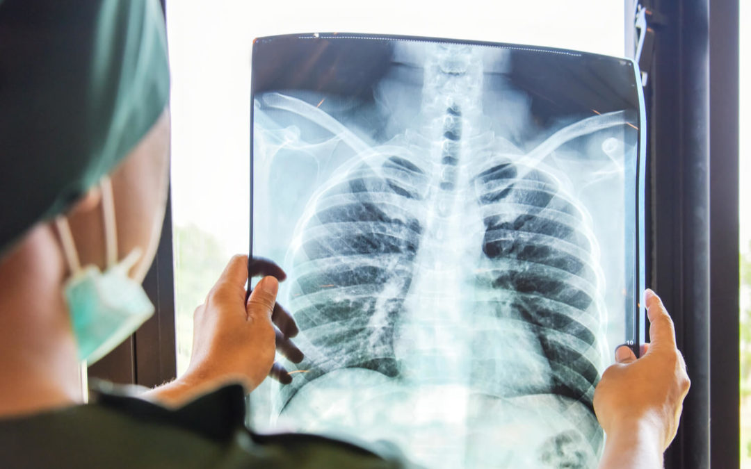 A doctor holding a lung cancer screening x-ray