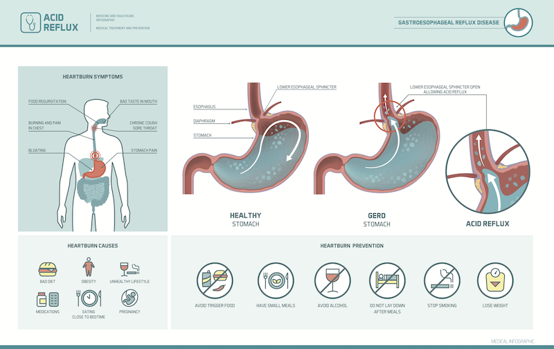 how-common-is-gerd-the-surgical-clinic