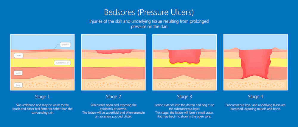 stages of pressure ulcers for wound treatment