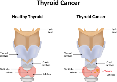 thyroid cancer diagram