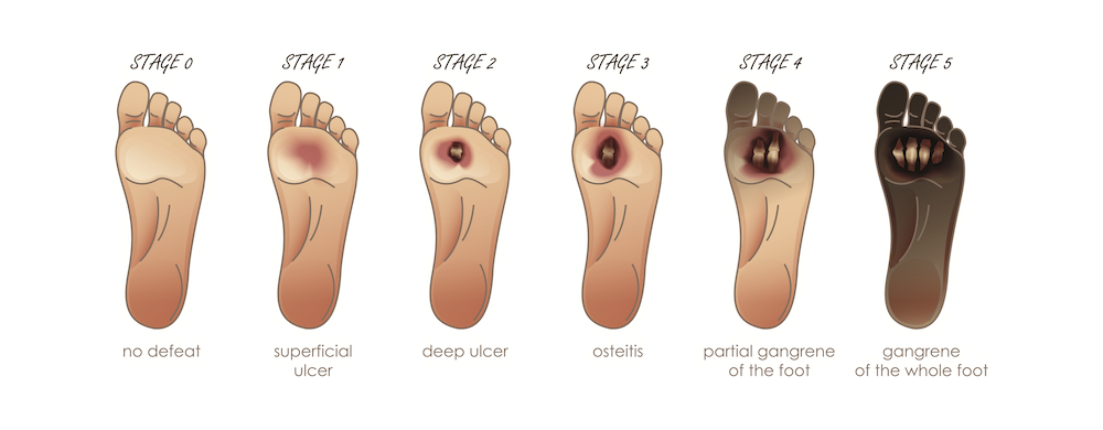 stages of wounds treated in nashville