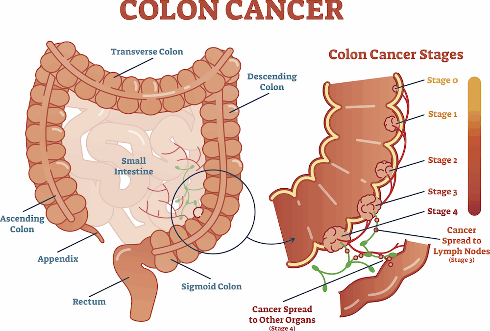Colorectal Cancer Surgery and Treatment Options