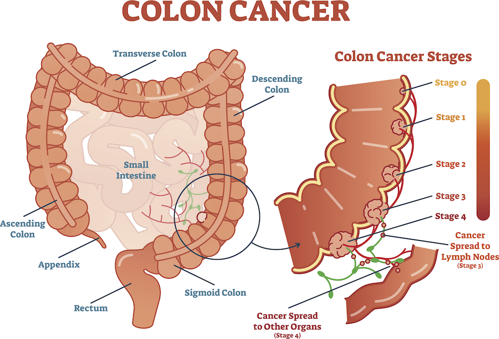 what is colorectal cancer