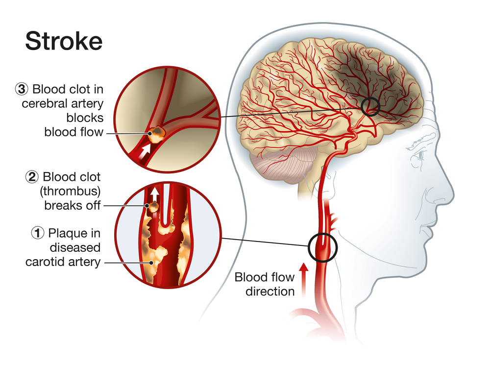 how to prevent a stroke