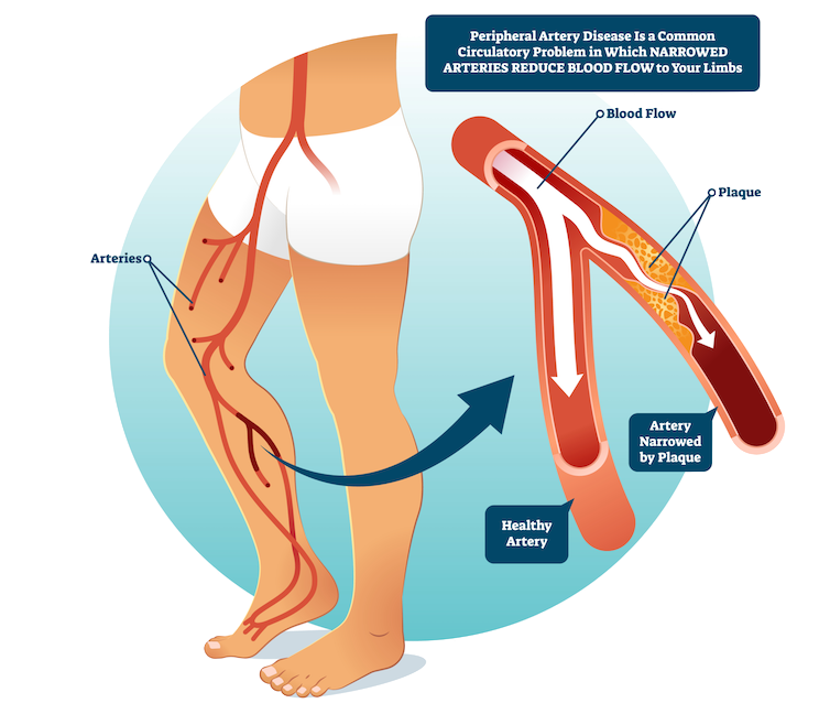 what is peripheral artery disease PAD