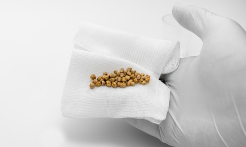 gallstones from removal surgery