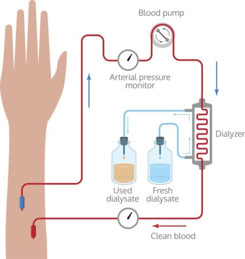 Dialysis Access Management | The Surgical Clinic, Nashville & Middle TN