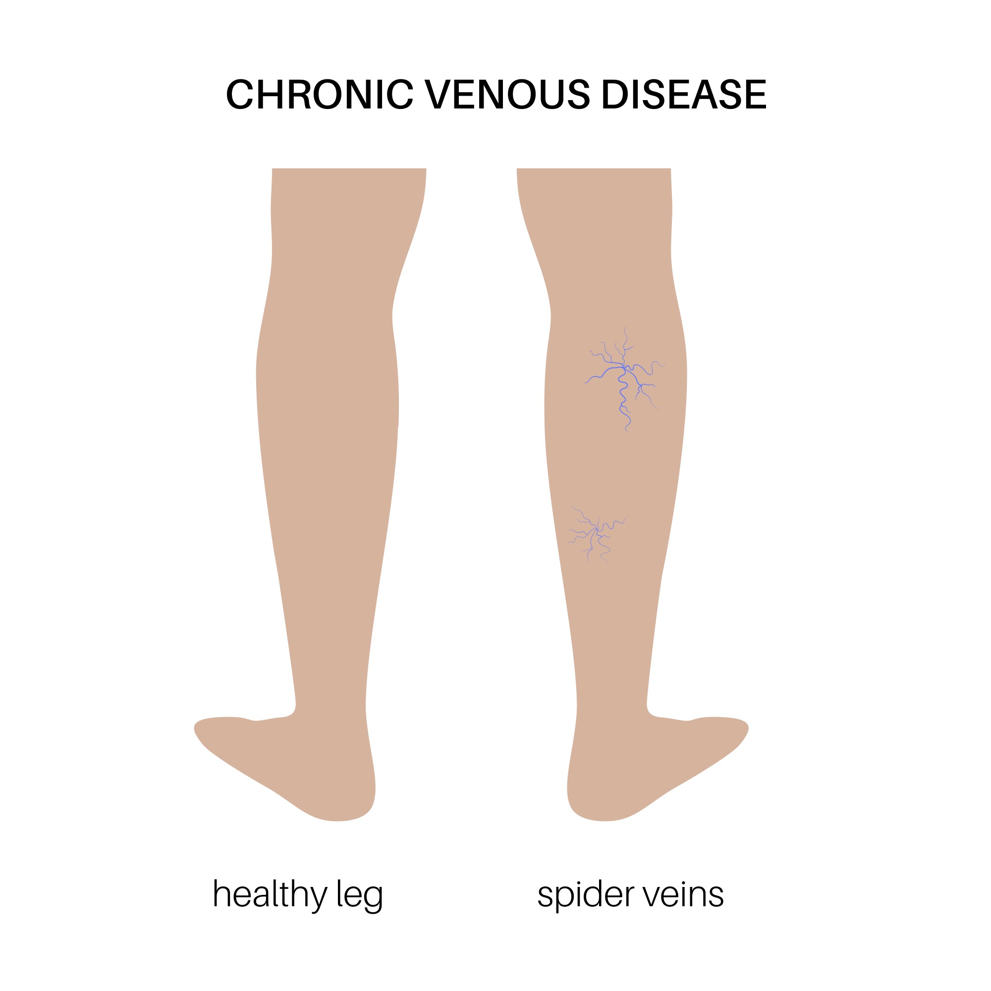 Spider veins vs normal leg veins diagram