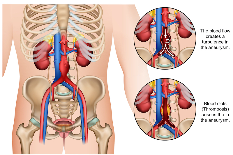 what is an abdominal aortic aneurysm vascular screening