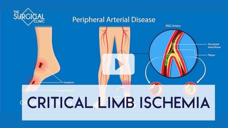 treating critical limb ischmeia in nashville at our vascular procedure center