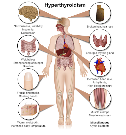 hyperthyroidism signs and symptoms of an overactive thyroid