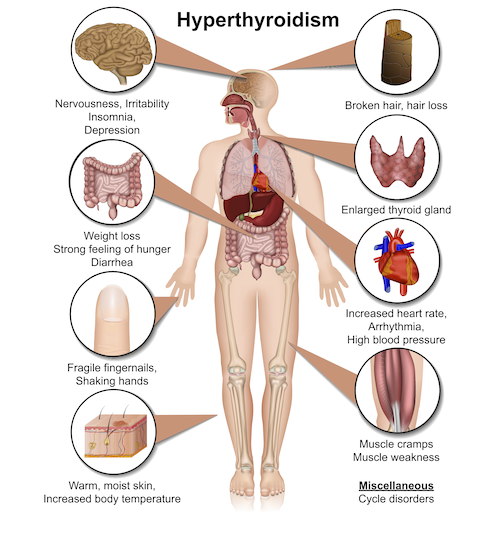 What Are The Symptoms Of Thyroid Problems In Females