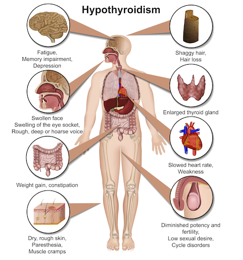 hypothyroidism signs and symptoms of underactive thyroid