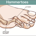 what does hammertoe look like hammertoes corn