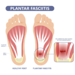 what is plantar fasciitis heel pain cause