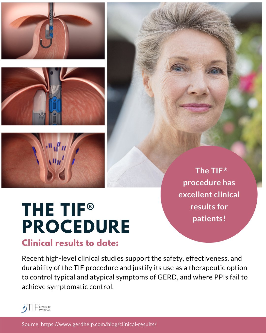 best surgery for GERD with the TIF procedure in Nashville