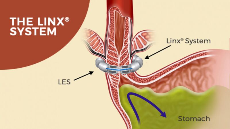 acid reflux treatment nashville with linx system