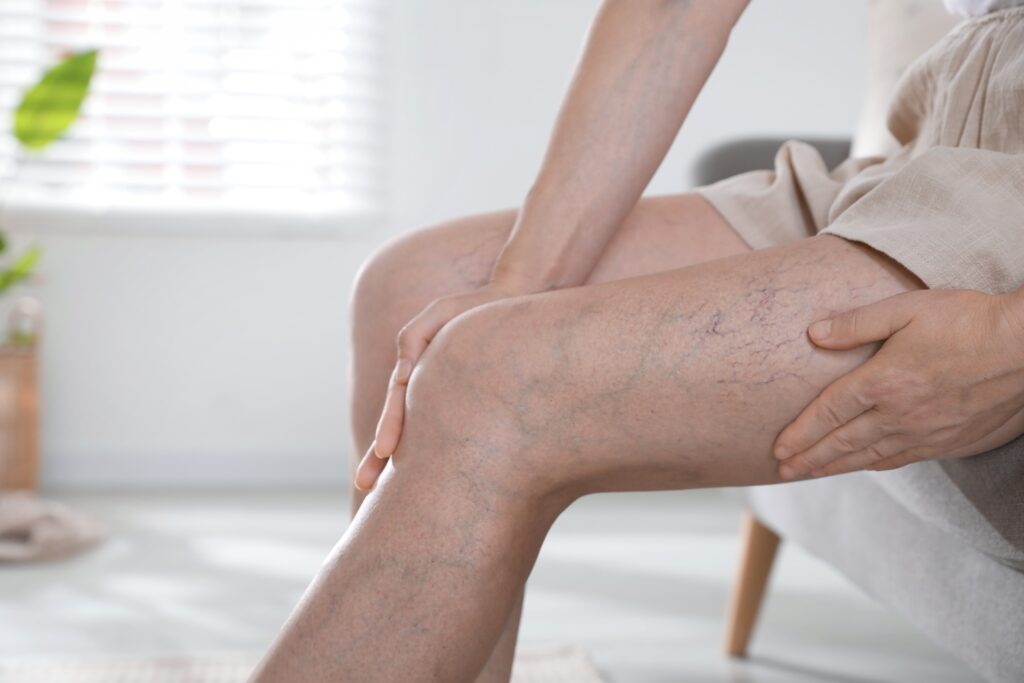 Older man with varicose veins on legs.