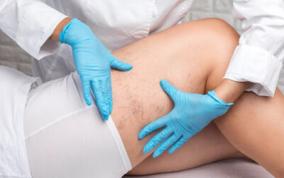 Common Vein Conditions and Effective Treatments